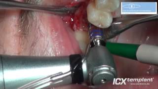Ein-ICX-templant-Implantat-im-Oberkiefer-mit-internem-Sinuslifft