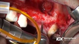 ICX-Templant-NL-21.11.2012